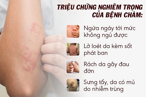 Triệu chứng chàm da