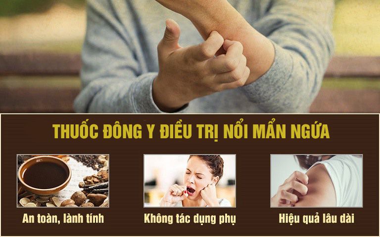 Cách chữa nổi mề đay khi mang thai bằng Đông y