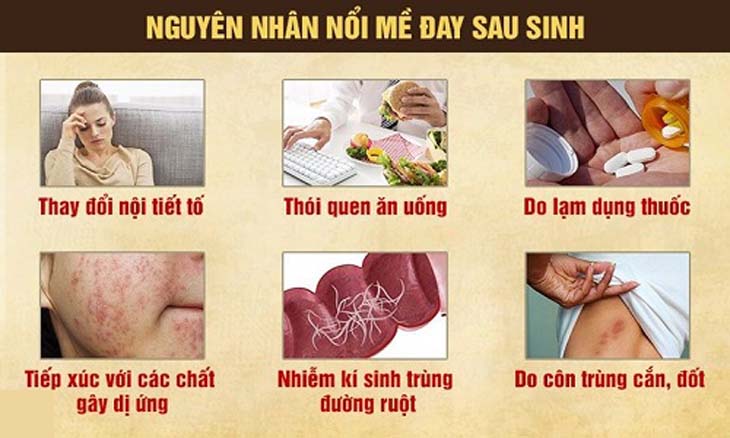 Nguyên nhân gây nổi mề đay sau sinh