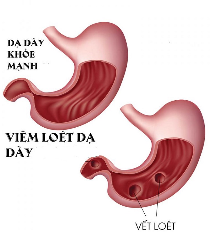 Viêm loét dạ dày là biến chứng bệnh dạ dày