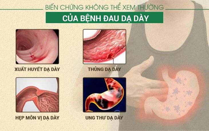 Những biến chứng phổ biến của bệnh đau dạ dày