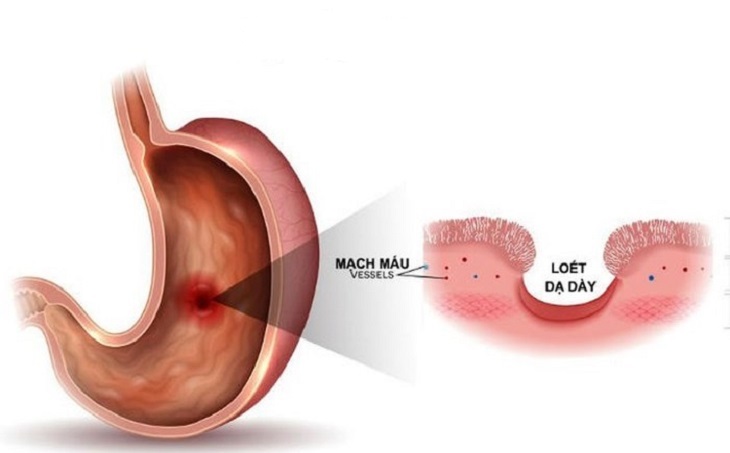 Đau dạ dày có mấy cấp độ