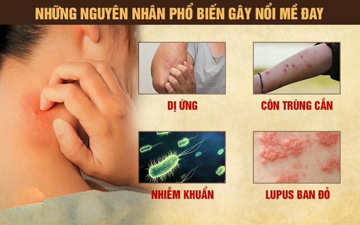 Nguyên nhân phổ biến gây nổi mề đay sau sinh