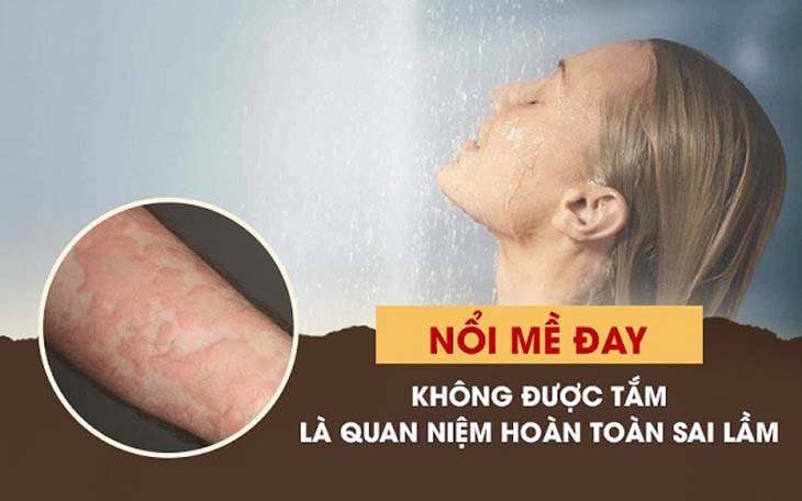 Nổi mề đay sau sinh có được tắm không