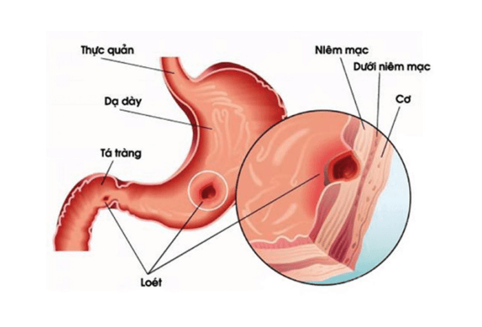 Vị trí đau dạ dày được quyết định bởi vị trí dạ dày trong ổ bụng