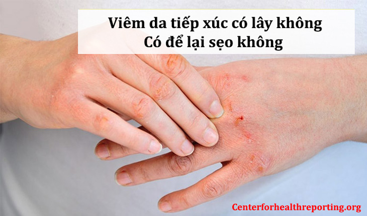 Nhiều người băn khoăn viêm da tiếp xúc có lây không, có để lại sẹo không?