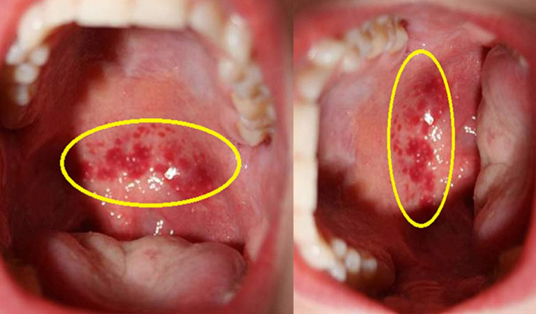 Viêm họng hạt - Một dạng của viêm họng mãn tính