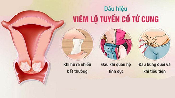 Dấu hiệu nhận biết viêm lộ tuyến độ 2