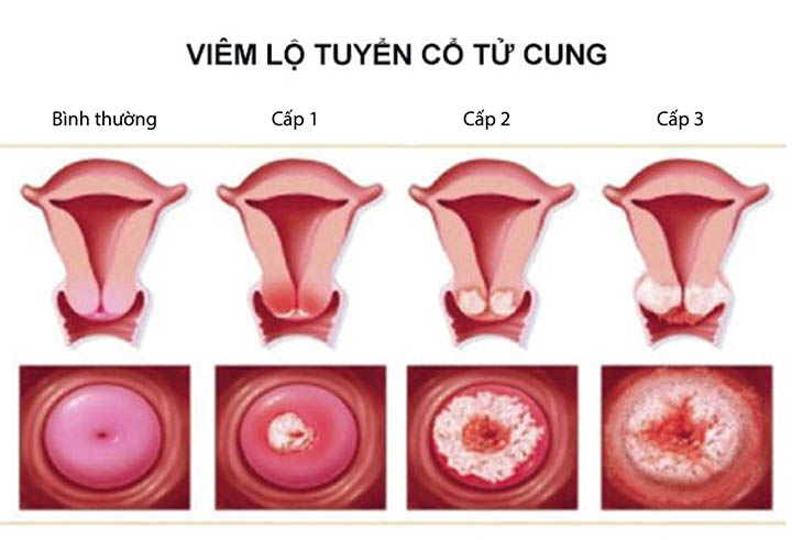 Hình ảnh viêm lộ tuyến cấp độ 2