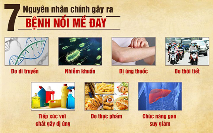 Bệnh mề đay có thể do nhiều nguyên nhân gây ra