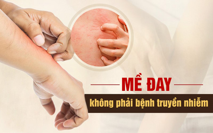 Bệnh mề đay có lây không? Mề đay không phải bệnh truyền nhiễm