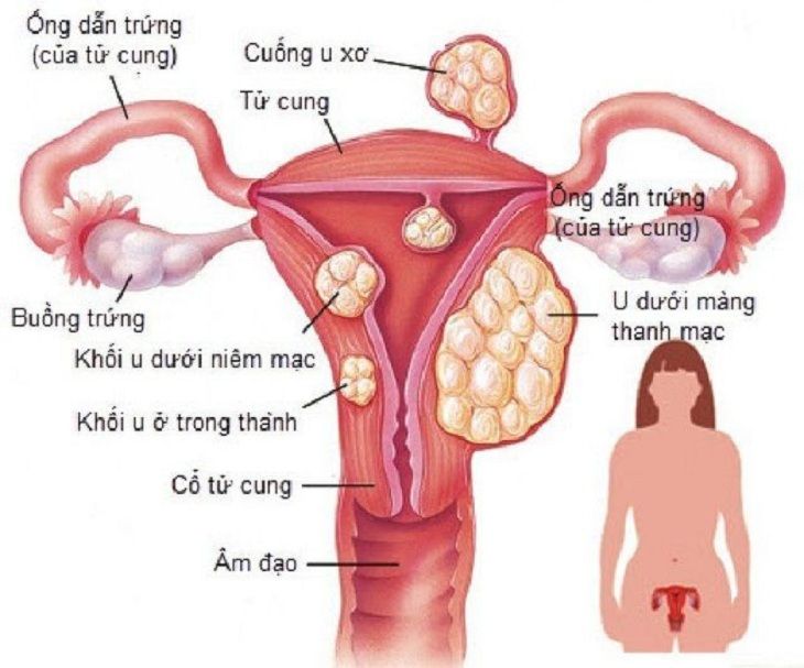 Viêm cổ tử cung sau sinh hình thành do sự rối loạn nội tiết trong cơ thể