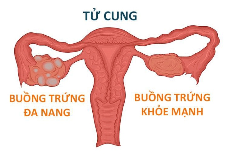 Buồng trứng đa nang có nên uống sữa đậu nành không?