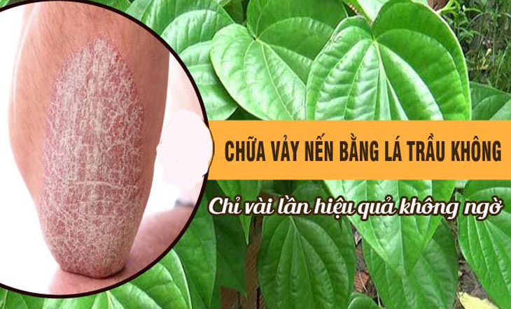 Tìm hiểu về những cách trị vảy nến bằng lá trầu không hiệu quả