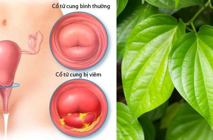 chữa viêm cổ tử cung tại nhà