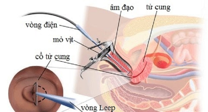 Chữa viêm lộ tuyến bằng Leep là phương pháp trị bệnh hiệu quả cao