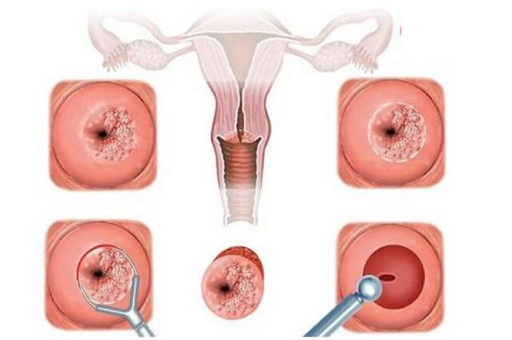 Sóng cao tần RFA điều trị viêm lộ tuyến hạn chế ảnh hưởng tổn thương lành tính