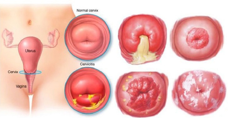 Thời gian điều trị viêm lộ tuyến cổ tử cung là thắc mắc của nhiều người bệnh