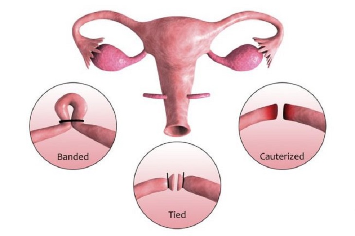 Phẫu thuật cắt và nối ống dẫn trứng