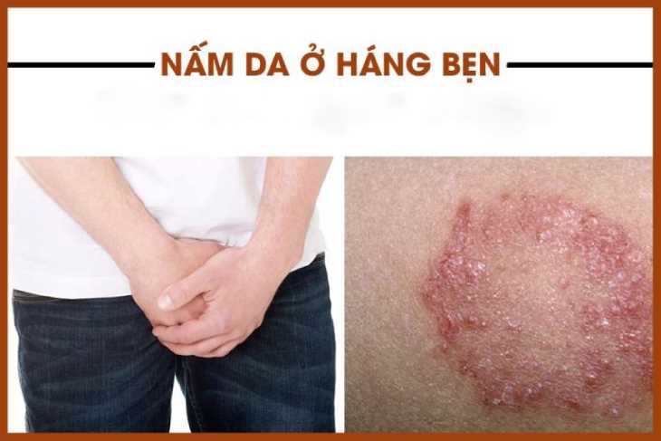 Nấm háng là một trong những nguyên nhân khiến da nổi mẩn, ngứa tại 2 bên háng