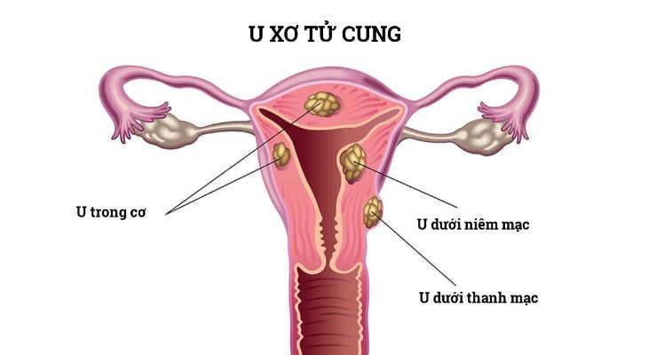 U xơ cổ tử cung là một nguyên nhân của rong kinh băng huyết