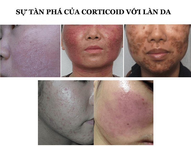 Lạm dụng Corticoid gây nên những tác hại khủng khiếp với làn da