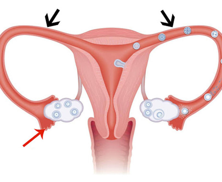 Tắc 1 bên vòi trứng có làm IUI được không là thắc mắc của nhiều người bệnh
