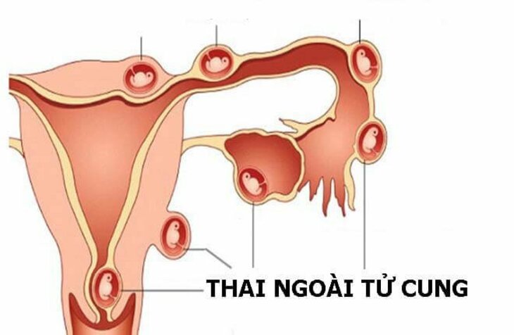 Mang thai ngoài tử cung gây nguy hiểm cho phụ nữ