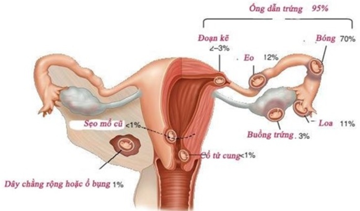 Vị trí của các đoạn trong vòi trứng