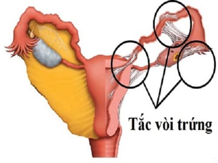 Bị tắc vòi trứng có chữa được không