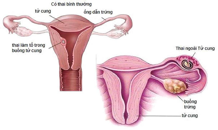 Hình ảnh tắc vòi trứng ở nữ