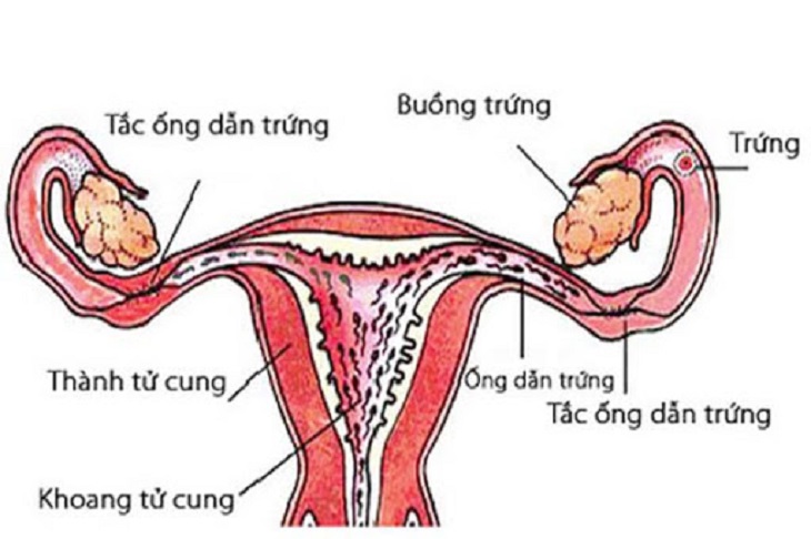 Tắc vòi trứng nguyên nhân phổ biến gây ra chứng hiểm muộn, vô sinh ở nữ giới