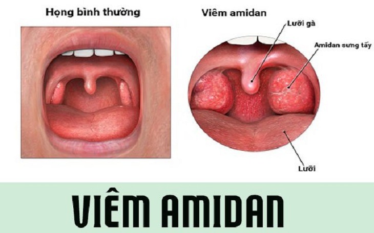 Viêm amidan có gây sốt không? Triệu chứng sốt sẽ gây cảm giác khó chịu mệt mỏi