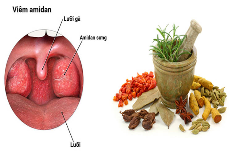 Sử dụng các bài thuốc Đông y để chữa bệnh viêm amidan ở trẻ