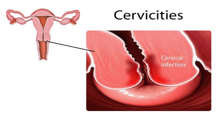 Viêm cổ tử cung cấp độ 2 là gì