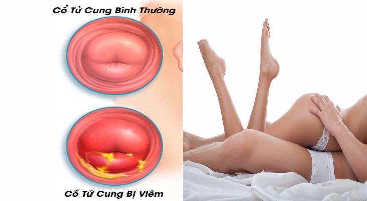 viêm cổ tử cung có quan hệ được không là thắc mắc của nhiều người bệnh