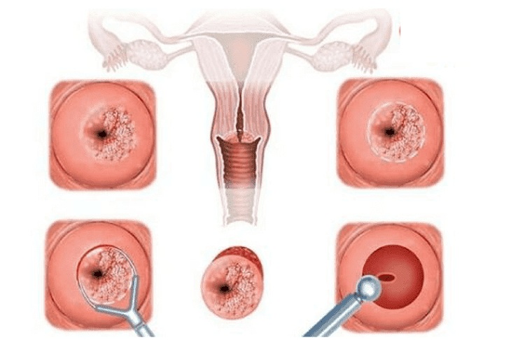 Viêm cổ tử cung giai đoạn mãn tính mất nhiều thời gian để chữa dứt điểm