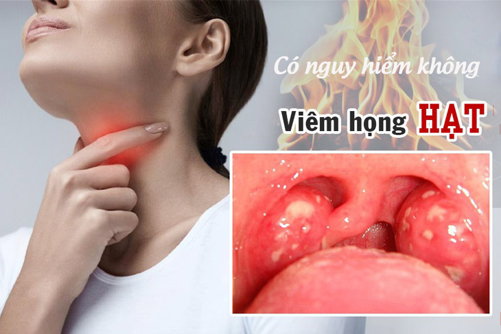 Tìm hiểu viêm họng hạt có nguy hiểm không