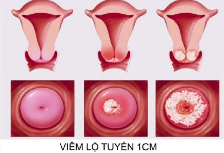 Viêm lộ tuyến 1cm là cấp độ 2 của chứng bệnh và mức độ trung bình