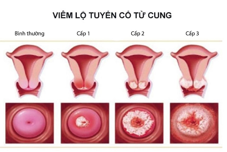 Viêm lộ tuyến cổ tử cung có nguy hiểm không? - Phụ thuộc vào cấp độ bệnh lý