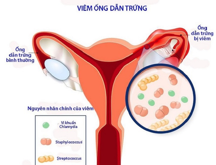 Viêm nhiễm là một trong những nguyên nhân gây tắc vòi trứng