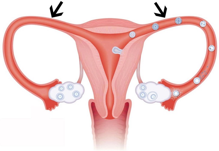 Viêm vòi trứng là bệnh lý phụ khoa nguy hiểm