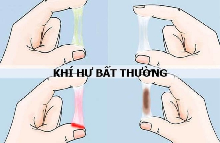 Khí hư bất thường là dấu hiệu nhận biết bệnh