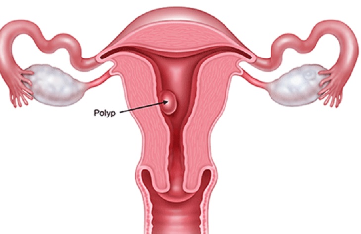 Kinh nguyệt ra ít kéo dài có màu đen có thể do mắc Polyp