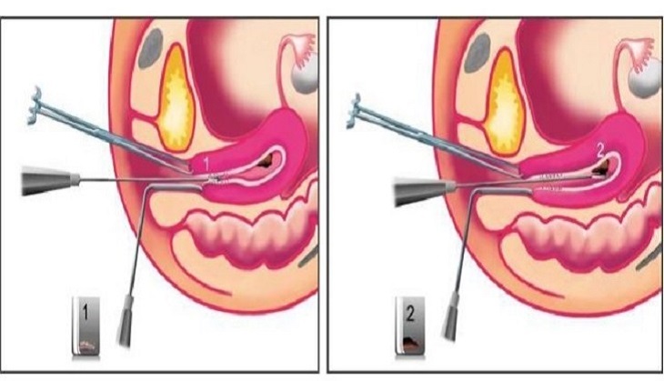 Một số trường hợp bác sĩ cần thực hiện thủ thuật ngoại khoa để điều trị rong kinh