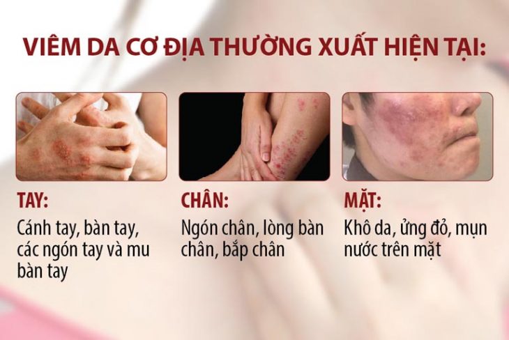 Viêm da cơ địa ở người lớn xuất hiện ở nhiều nơi trên cơ thể người bệnh