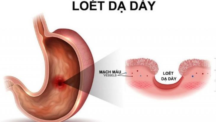 Những người bị bệnh dạ dày nên hạn chế dùng thảo dược này