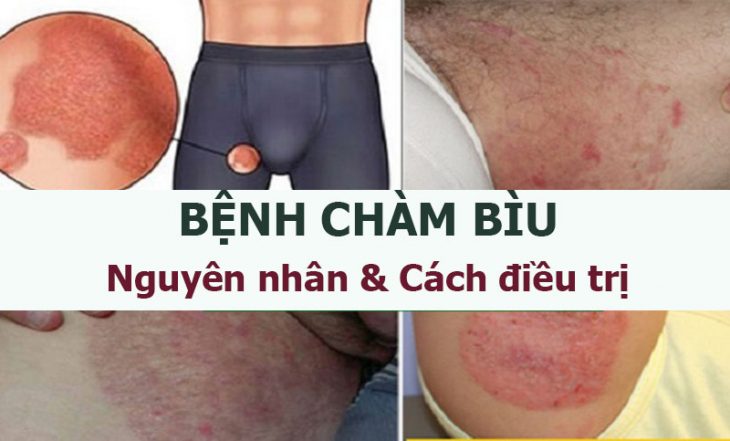 Chàm bìu là một trong những nam khoa gây cho người bệnh nhiều khó chịu và đau đớn