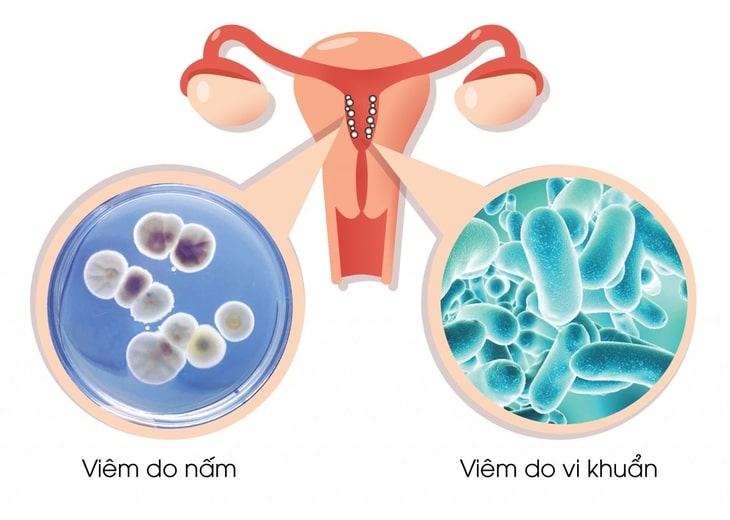 Bệnh nấm phụ khoa có nguy hiểm không là thắc mắc của nhiều bệnh nhân