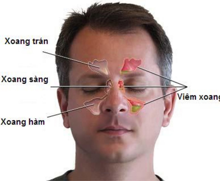 Bệnh viêm xoang sàng sau xảy ra do sự tấn công của nấm và vi khuẩn